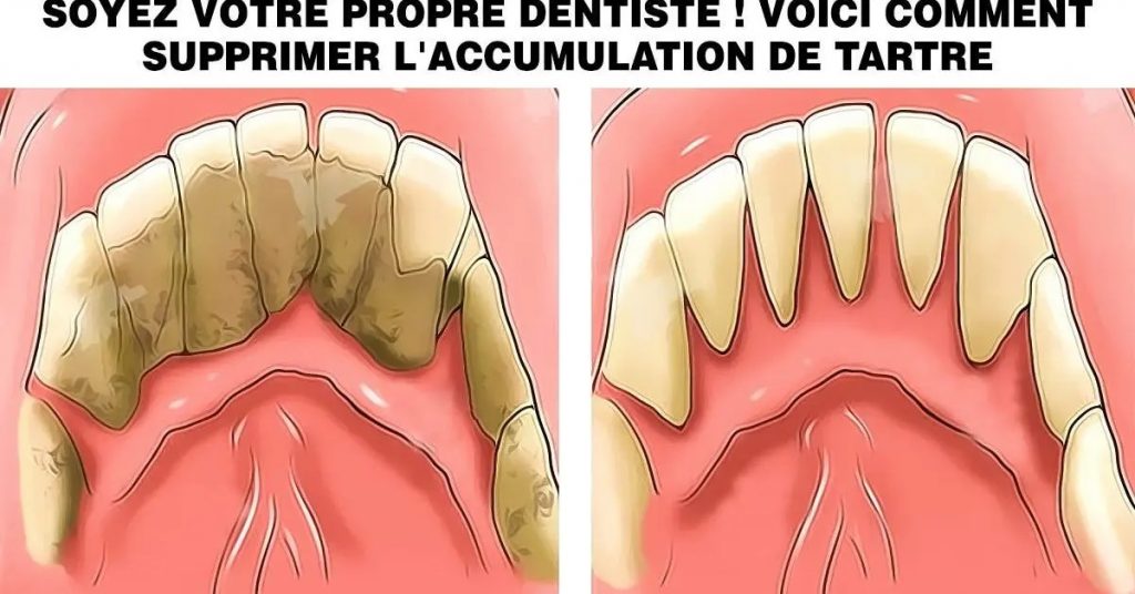 Le Tartre Provoque Une Mauvaise Haleine Et Des Caries Voici Comment L