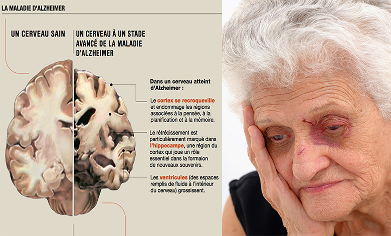 7 gestes efficaces pour éviter la maladie alzheimer