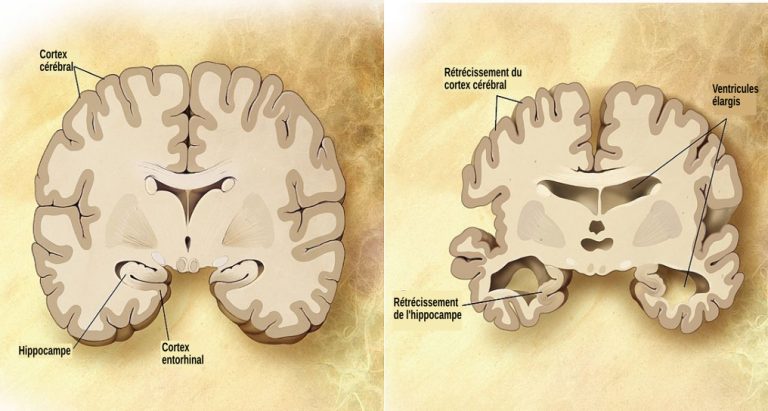 Les maladies neurodégénérative