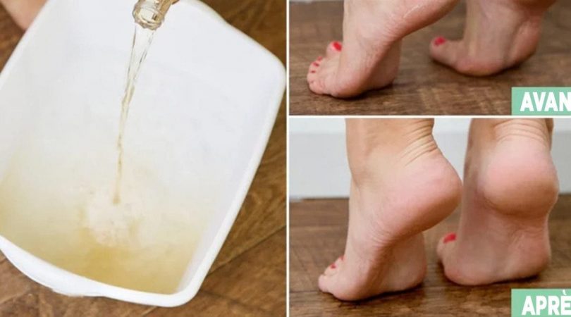 Voici comment adoucir les pieds secs avec des astuces naturelles