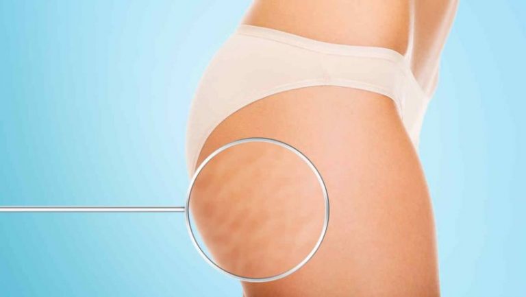 6 Exercices Faciles Pour Perdre Sa Cellulite En Seulement 2 Semaines