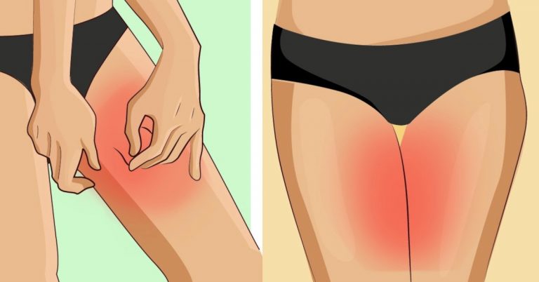 4 astuces contre le frottement des cuisses