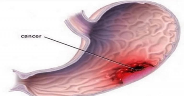 Le cancer de l’estomac est un tueur silencieux : les signes à détecter au déclenchement de la maladie