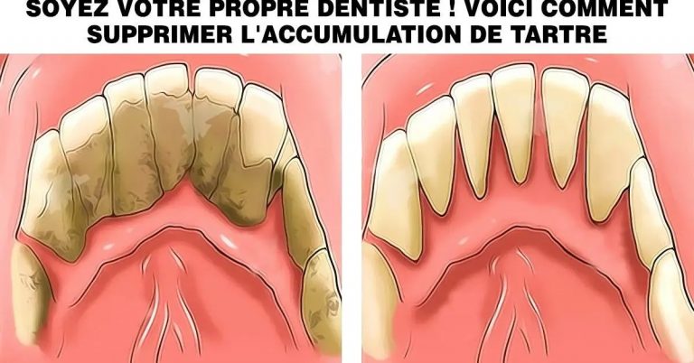 Le tartre provoque une mauvaise haleine et des caries voici comment l’éliminer naturellement à la maison