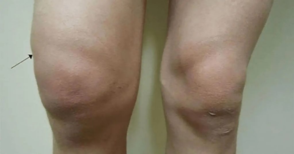 Eliminez la rétention d’eau avec cette astuce naturelle