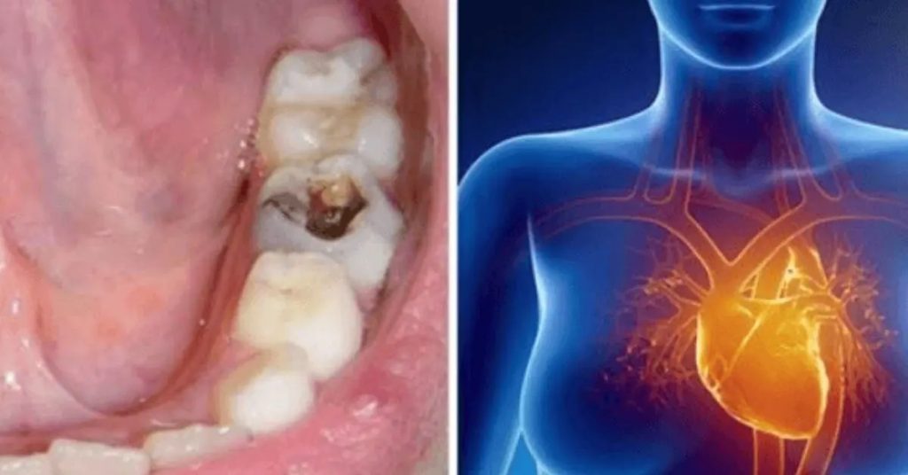 Les caries dentaires peuvent causer une infection et toucher d’autres organes du corps