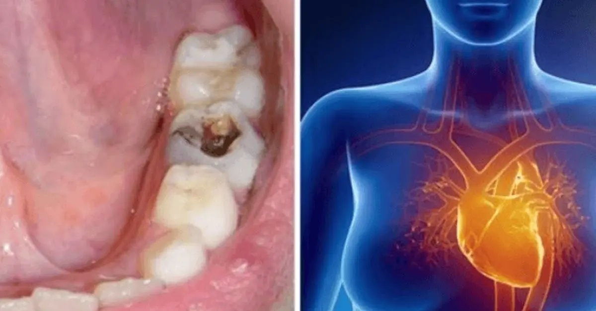 Les caries dentaires peuvent causer une infection et toucher d’autres organes du corps