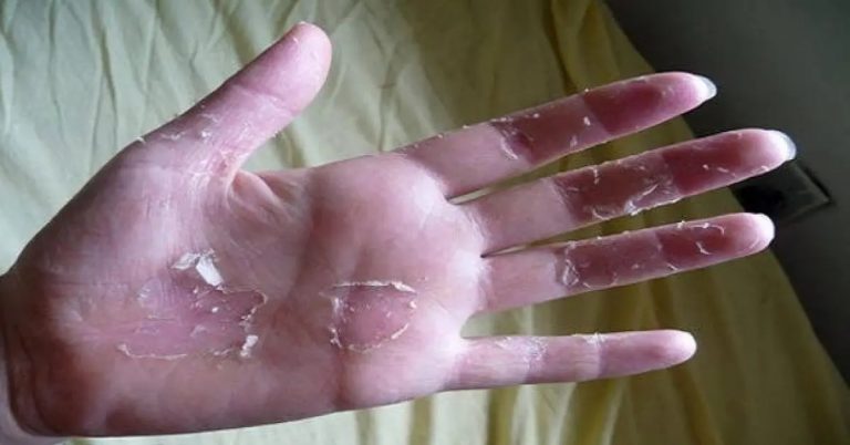 3 astuces naturelles pour lutter contre les mains qui pèlent